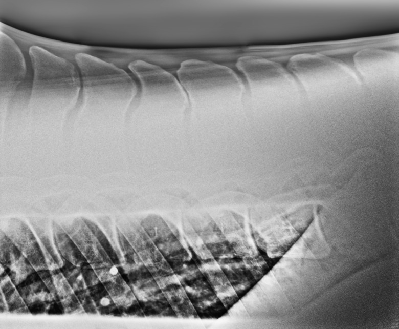 Genvariant kan förutsäga graden av kissing spines